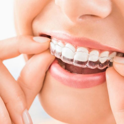 Consider-Invisalign-Clear-Aligners